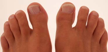 problema en los dedos de los pies sevilla podologo julia franco podologa