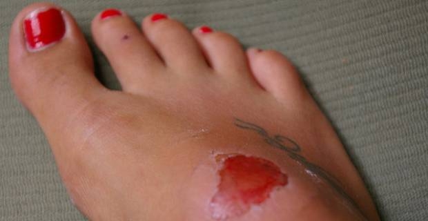 como-curar-heridas-infectadas-default-31604-0