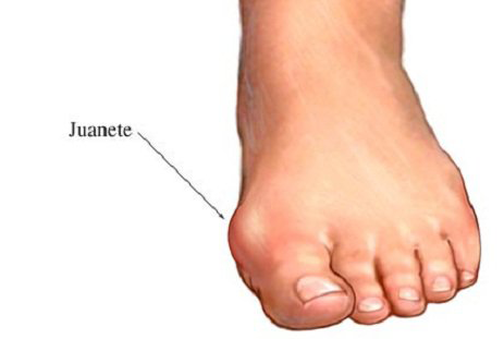 curar, operar juanete sevilla